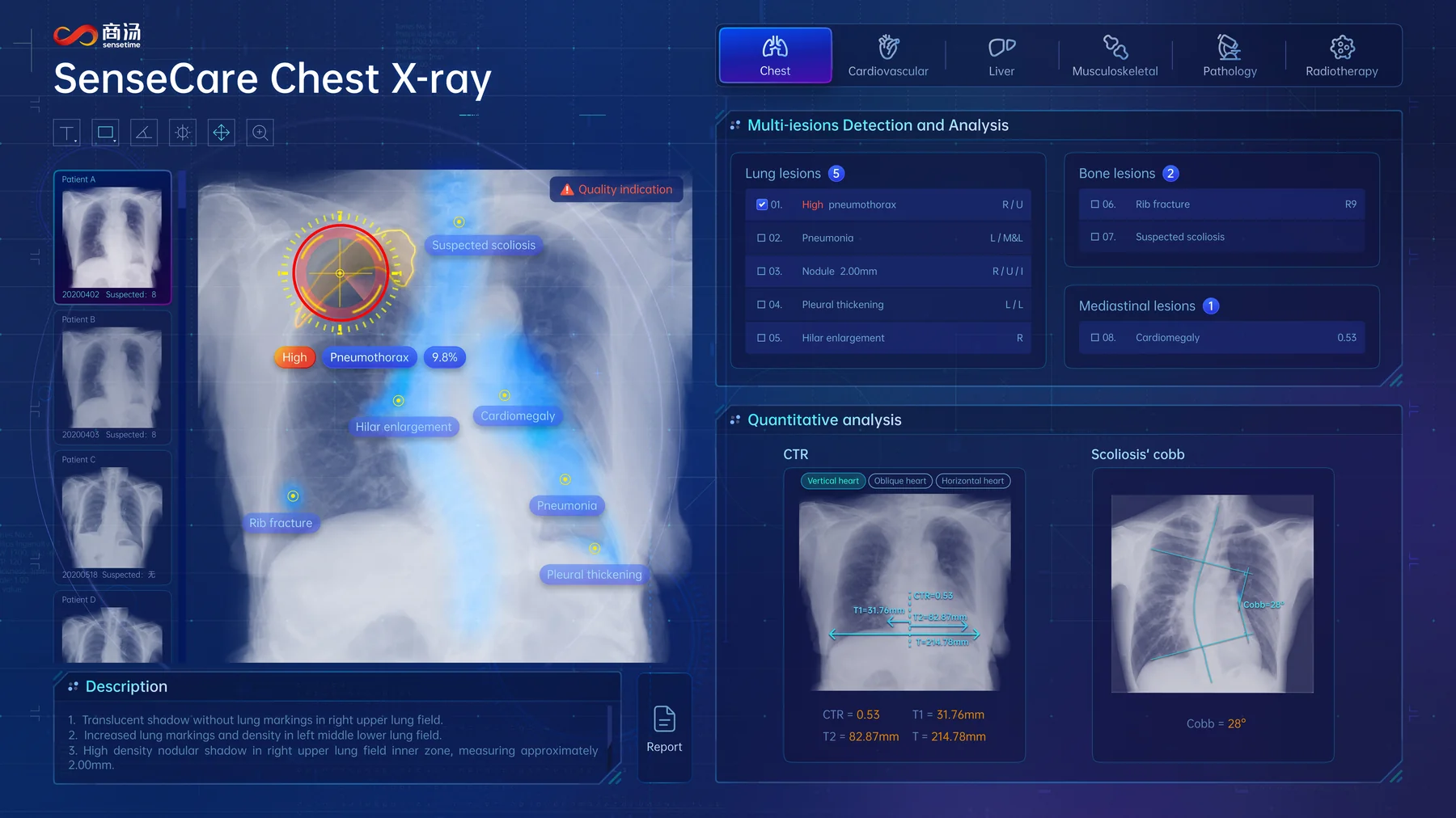 SenseCare chest X-ray intelligent analysis interface